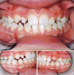 Orthodontic Specialists Before