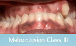 Malocclusion Class 1