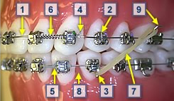 Orthodontic Terms