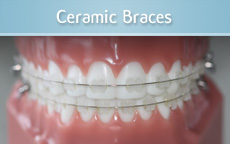 Ceramic Braces