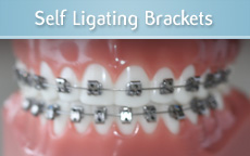 Self Ligating Braces